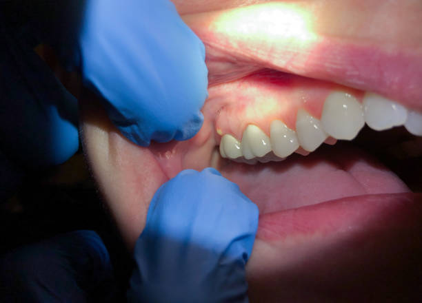 Best Knocked-Out Tooth (Avulsed Tooth) Treatment in Blue Point, NY